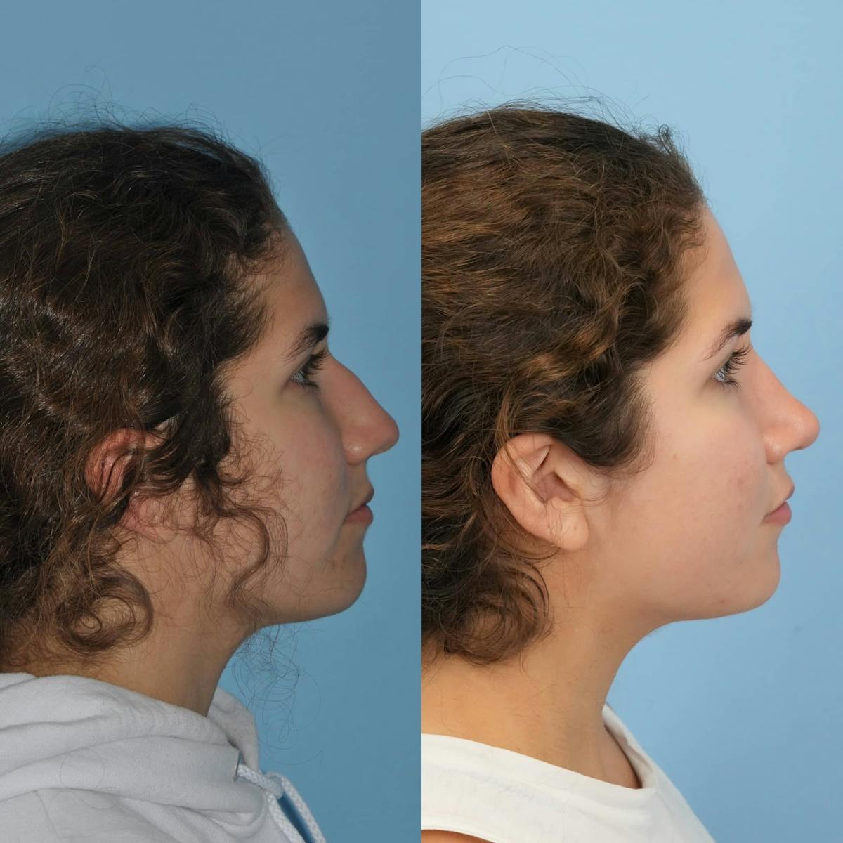 Rhinoplasty Before & After Gallery - Patient 384144 - Image 4