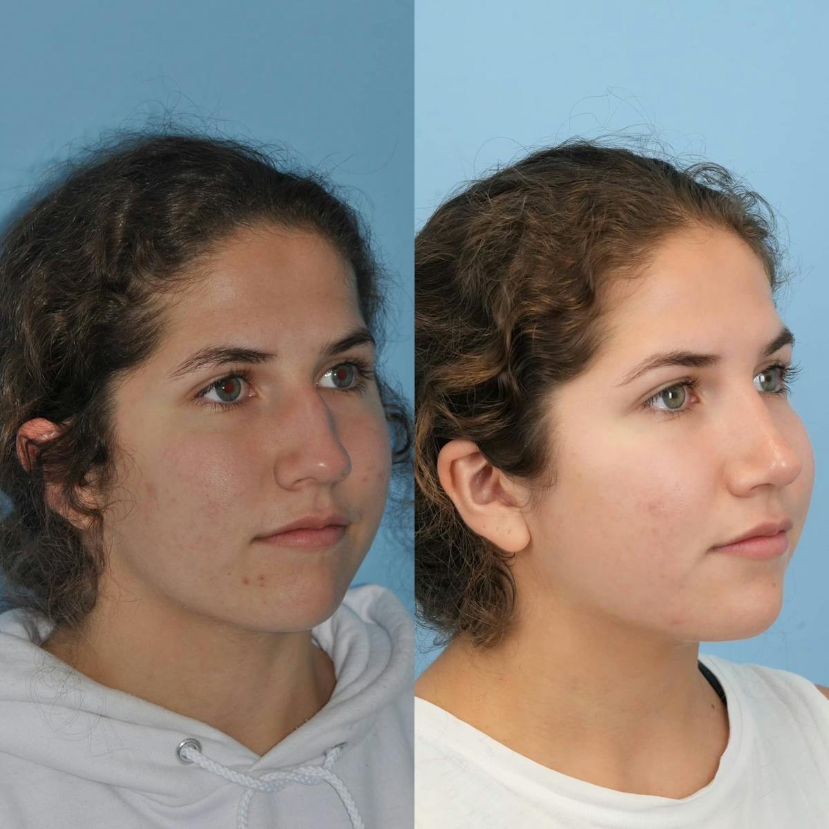 Rhinoplasty Before & After Gallery - Patient 384144 - Image 5