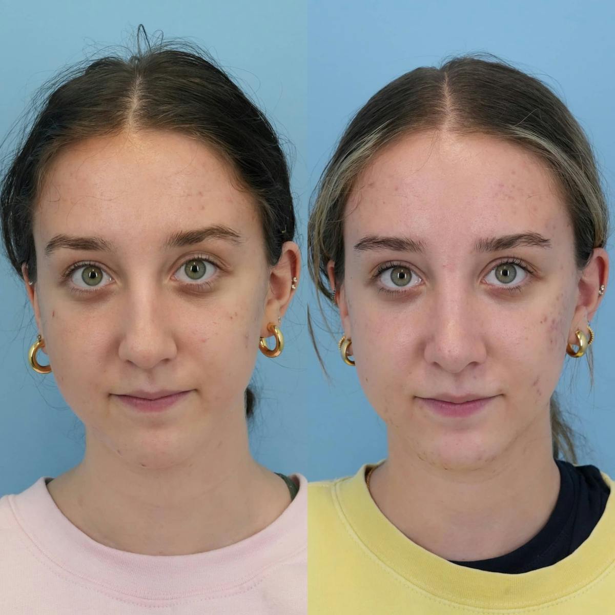 Rhinoplasty Before & After Gallery - Patient 252032 - Image 1