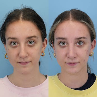 Rhinoplasty Before & After Gallery - Patient 252032 - Image 1