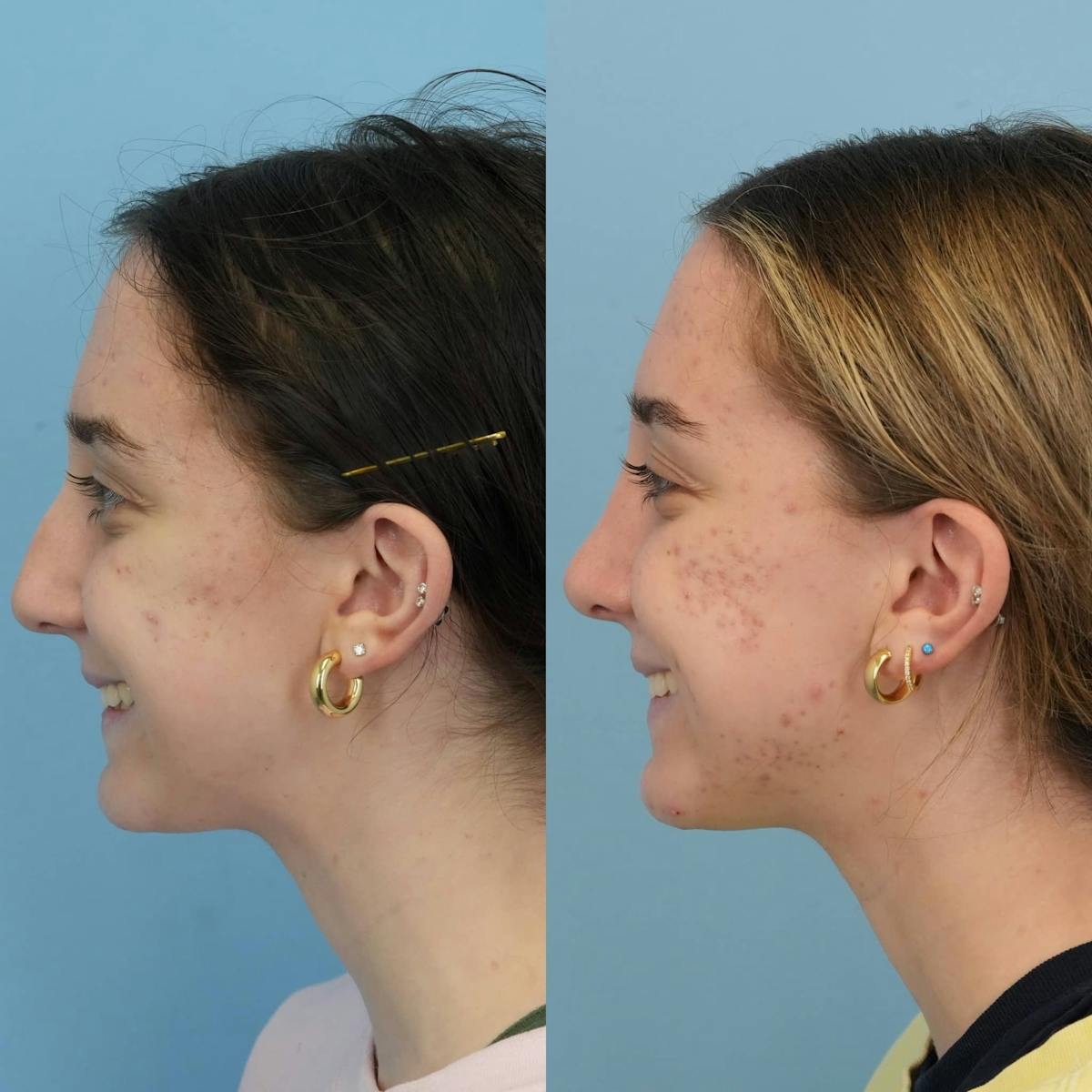 Rhinoplasty Before & After Gallery - Patient 252032 - Image 2