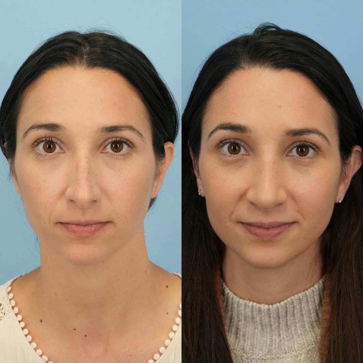 Rhinoplasty Before & After Gallery - Patient 273797 - Image 1