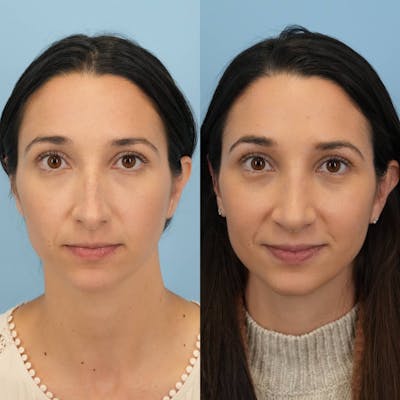 Rhinoplasty Before & After Gallery - Patient 273797 - Image 1