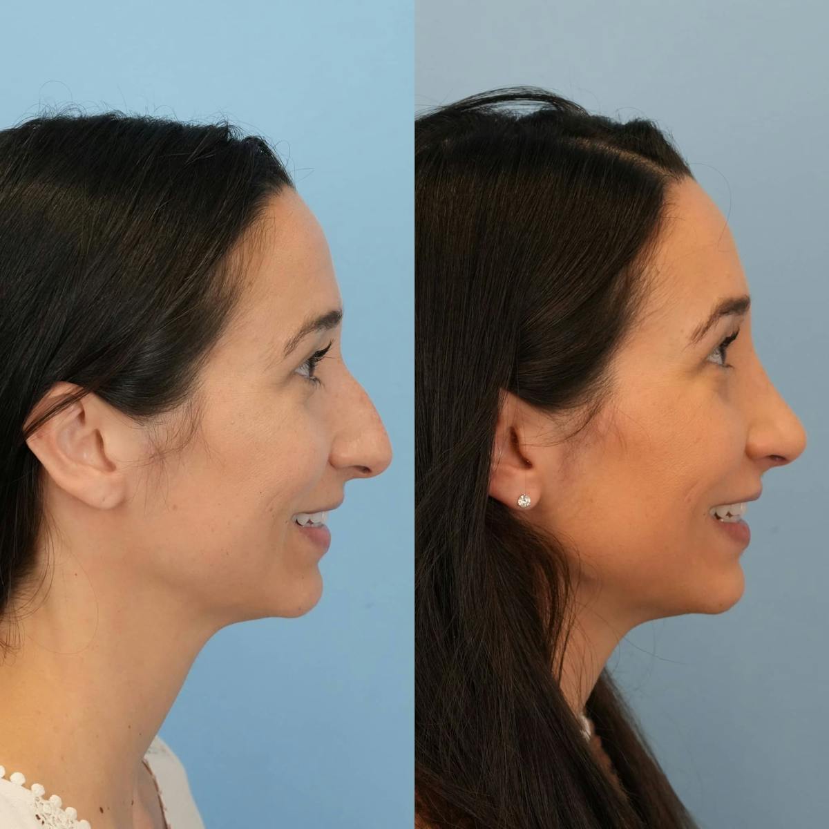 Rhinoplasty Before & After Gallery - Patient 273797 - Image 3