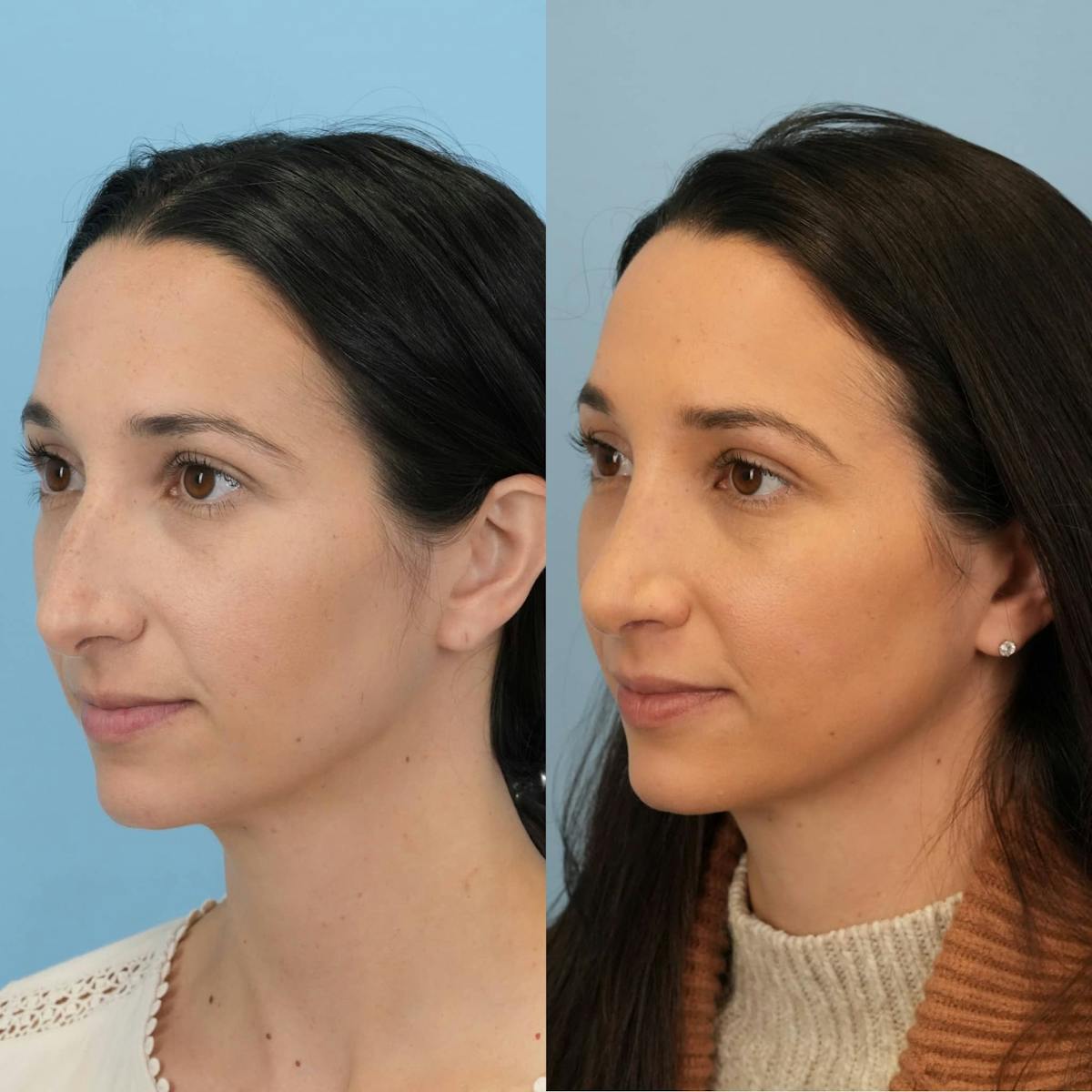 Rhinoplasty Before & After Gallery - Patient 273797 - Image 5