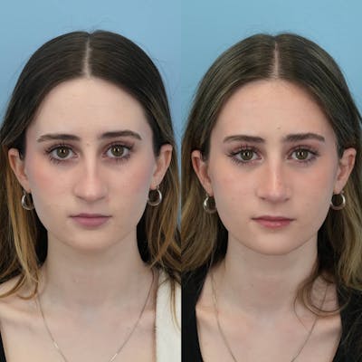 Rhinoplasty Before & After Gallery - Patient 194832 - Image 1