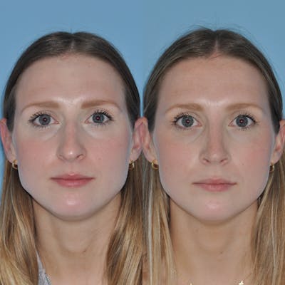 Rhinoplasty Before & After Gallery - Patient 305150 - Image 1