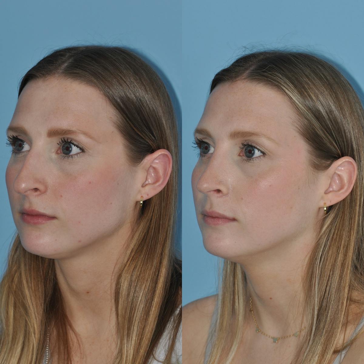 Rhinoplasty Before & After Gallery - Patient 305150 - Image 2