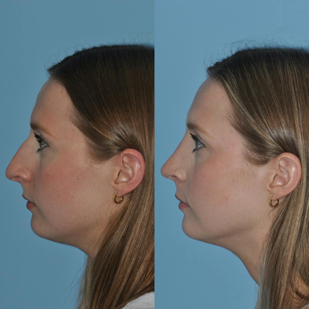 Rhinoplasty Before & After Gallery - Patient 305150 - Image 4