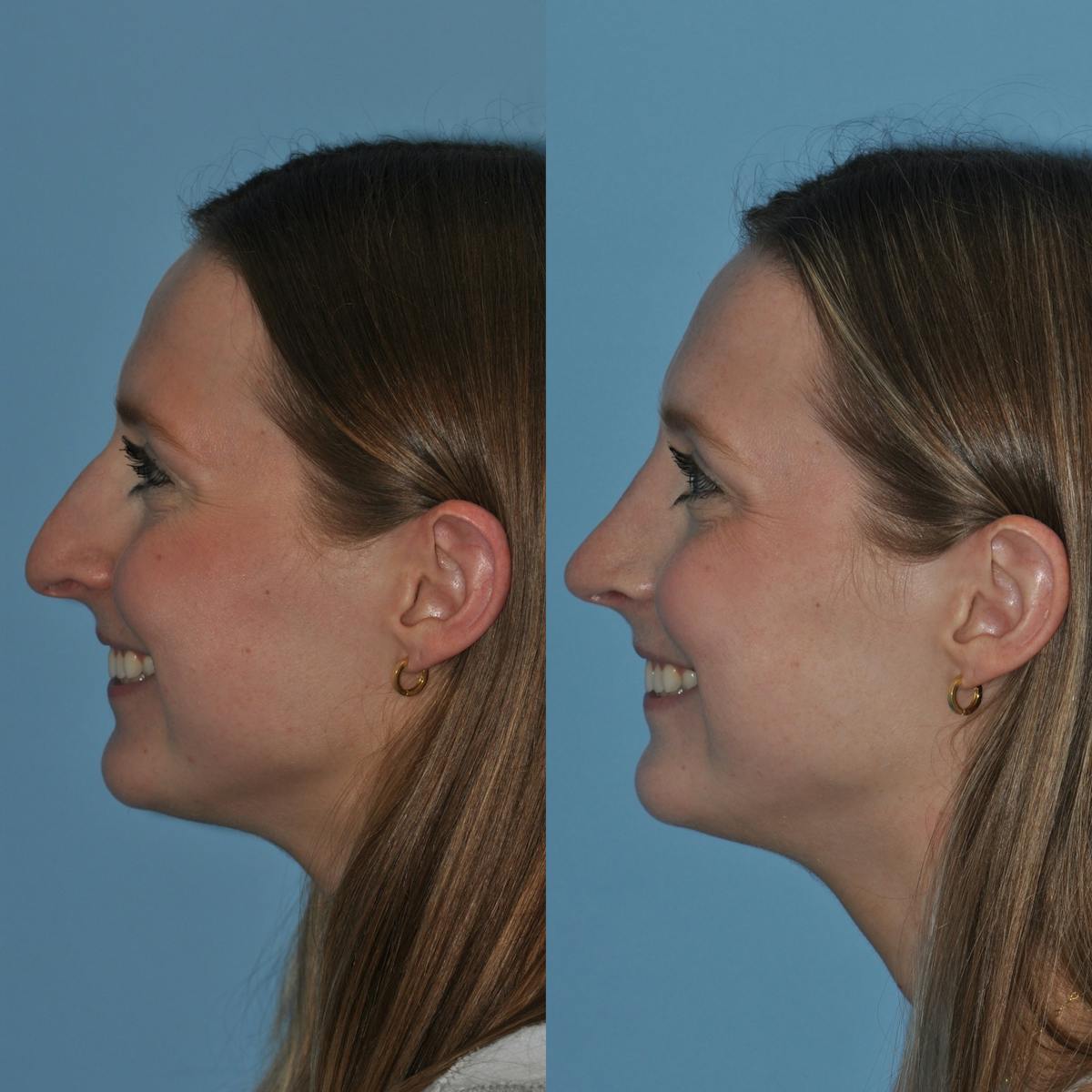 Rhinoplasty Before & After Gallery - Patient 305150 - Image 7