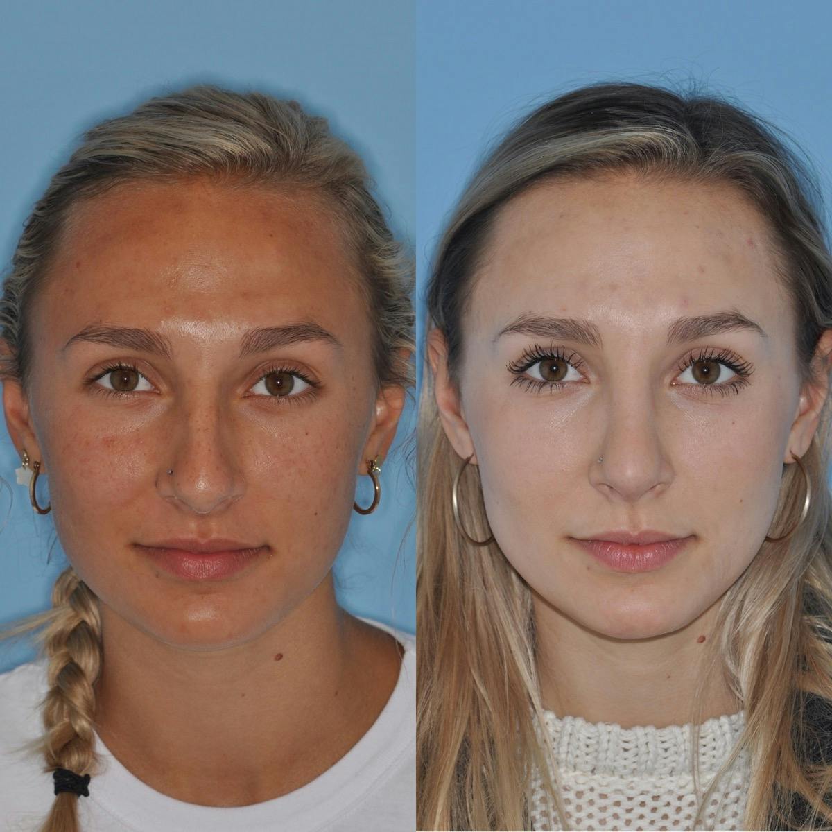 Rhinoplasty Before & After Gallery - Patient 295543 - Image 1