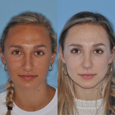 Rhinoplasty Before & After Gallery - Patient 295543 - Image 1