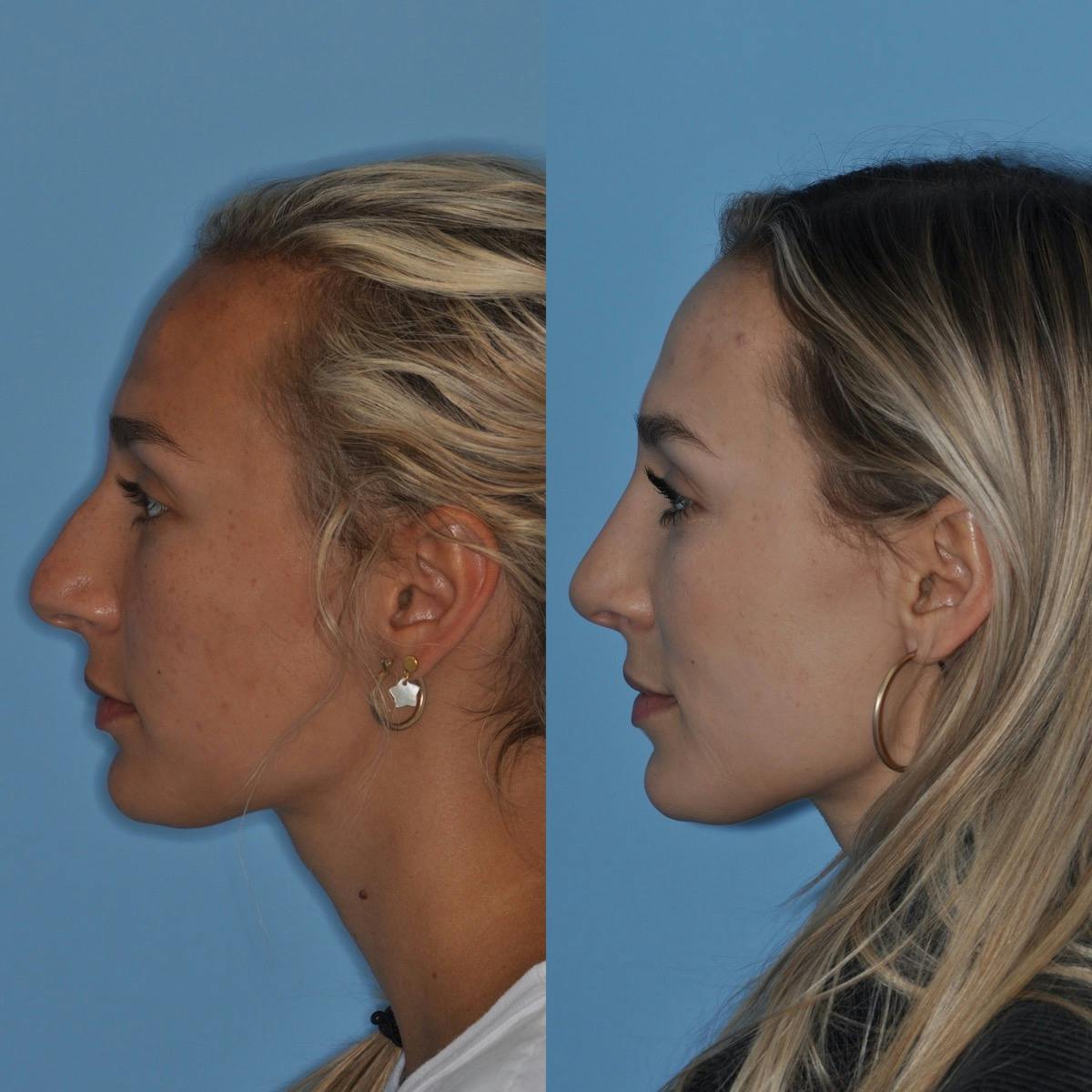 Rhinoplasty Before & After Gallery - Patient 295543 - Image 3