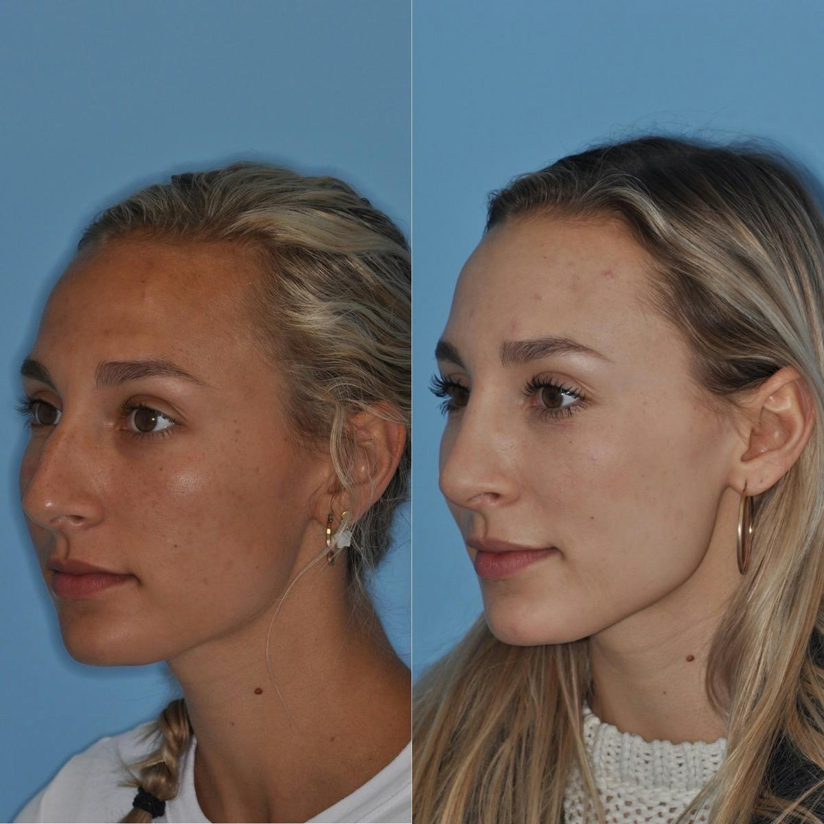 Rhinoplasty Before & After Gallery - Patient 295543 - Image 4