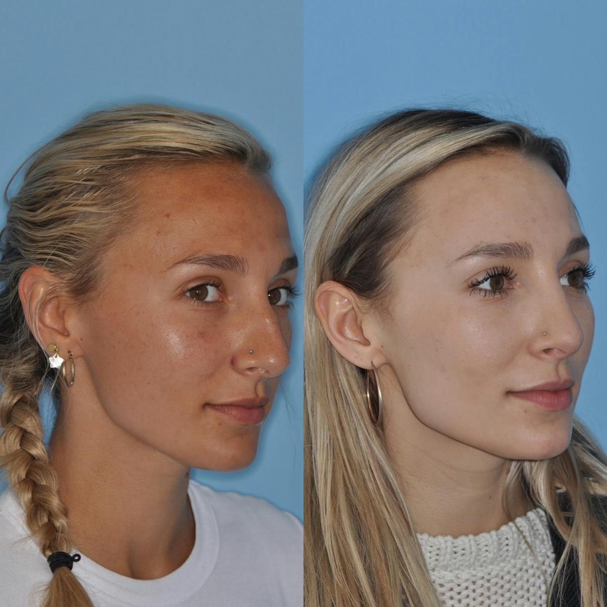 Rhinoplasty Before & After Gallery - Patient 295543 - Image 5