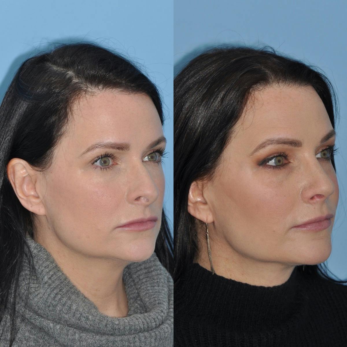 Rhinoplasty Before & After Gallery - Patient 193887 - Image 2
