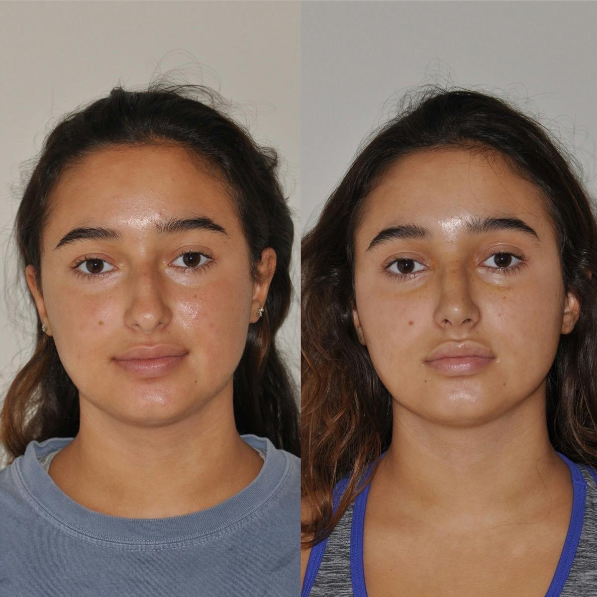Rhinoplasty Before & After Gallery - Patient 200195 - Image 1