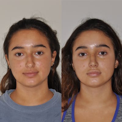 Rhinoplasty Before & After Gallery - Patient 200195 - Image 1