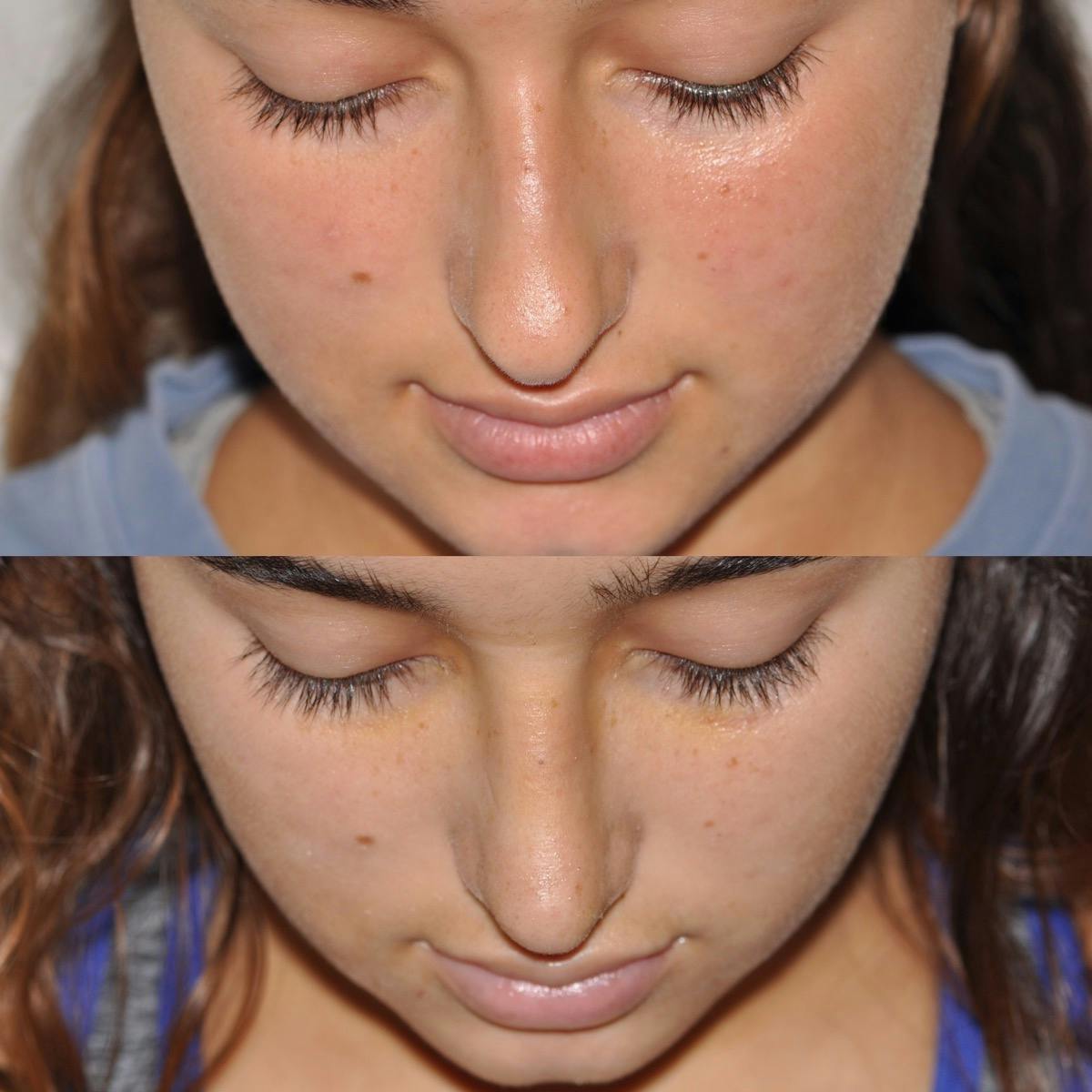 Rhinoplasty Before & After Gallery - Patient 200195 - Image 4