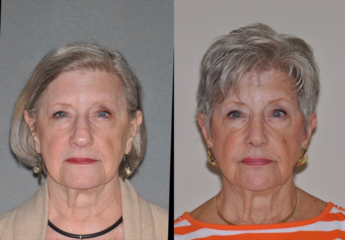 Rhinoplasty Before & After Gallery - Patient 346232 - Image 1