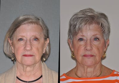 Rhinoplasty Before & After Gallery - Patient 346232 - Image 1