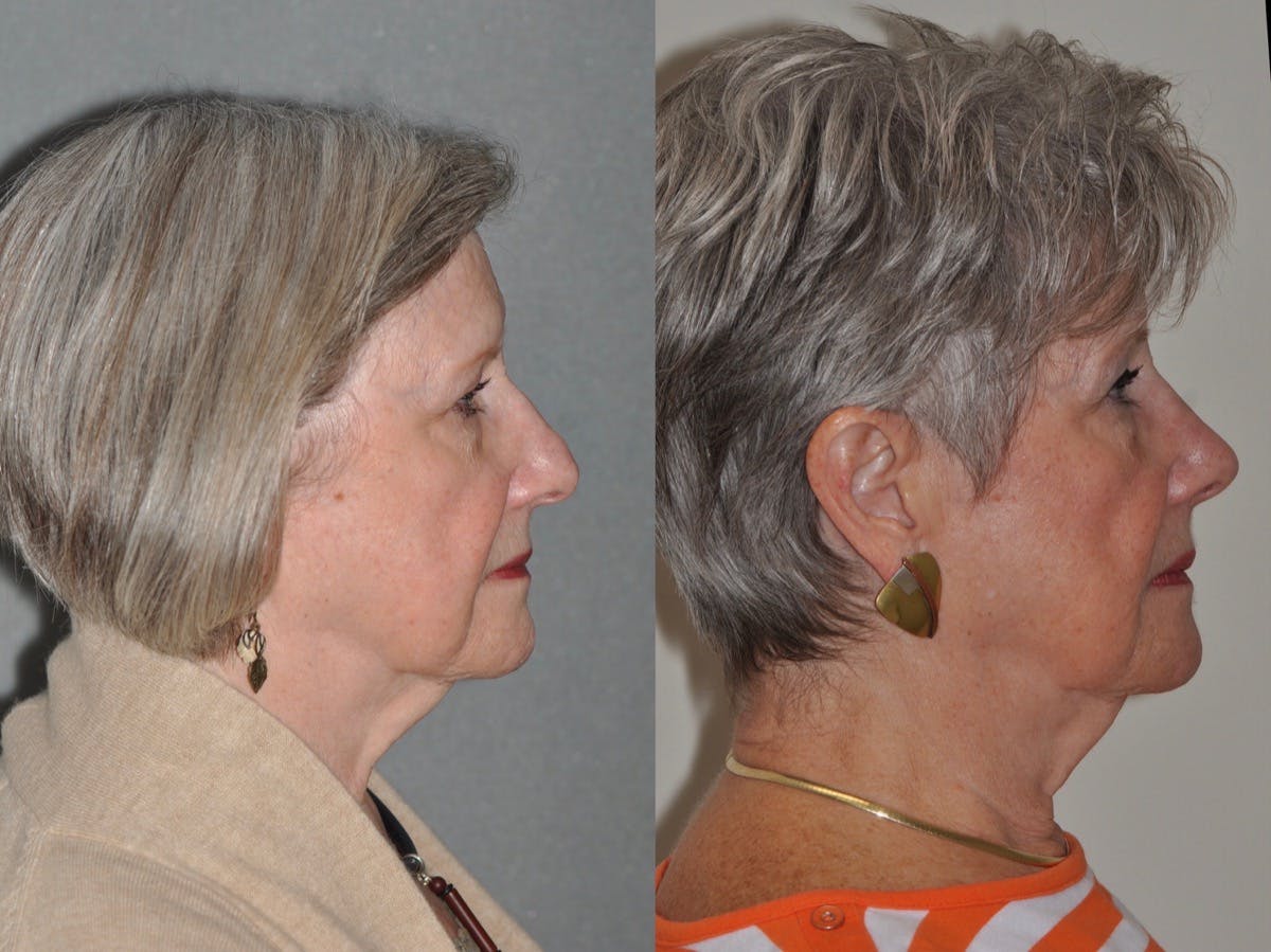 Rhinoplasty Before & After Gallery - Patient 346232 - Image 3