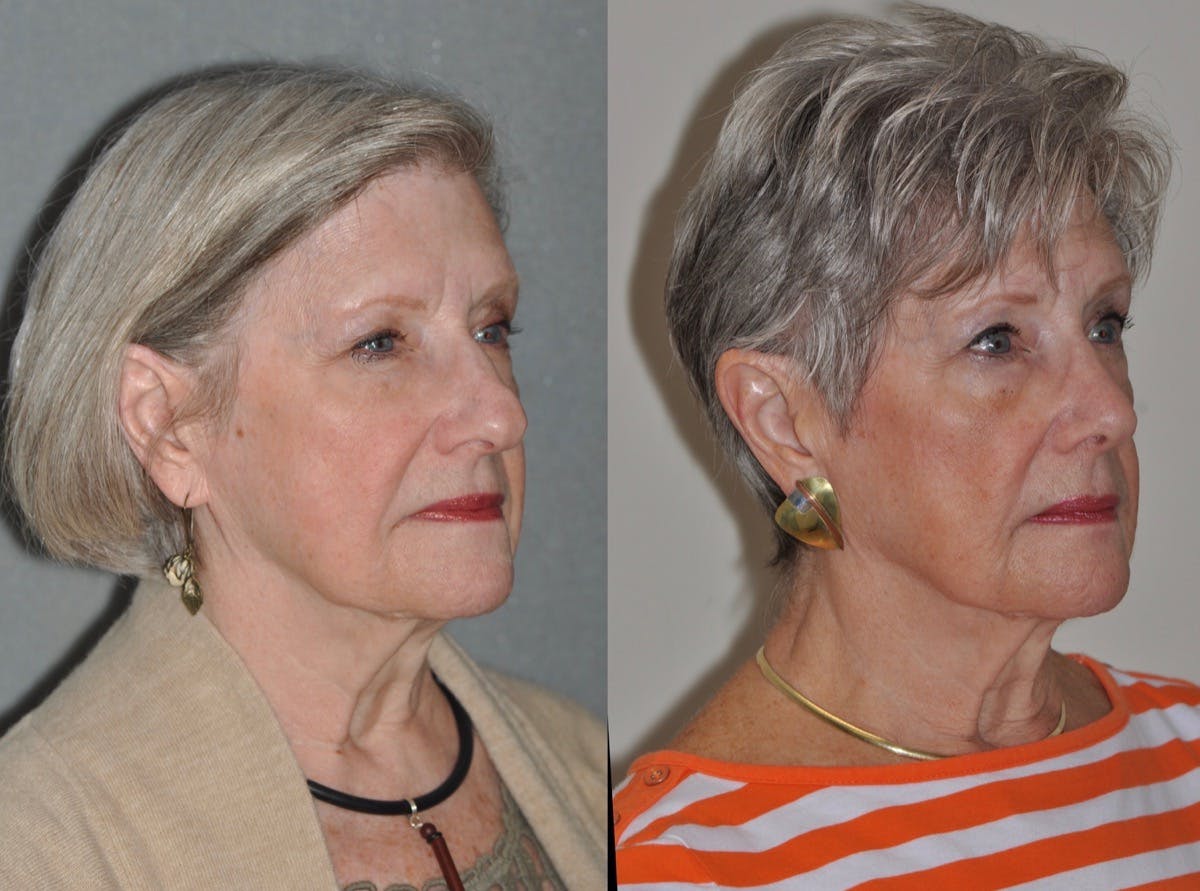 Rhinoplasty Before & After Gallery - Patient 346232 - Image 4