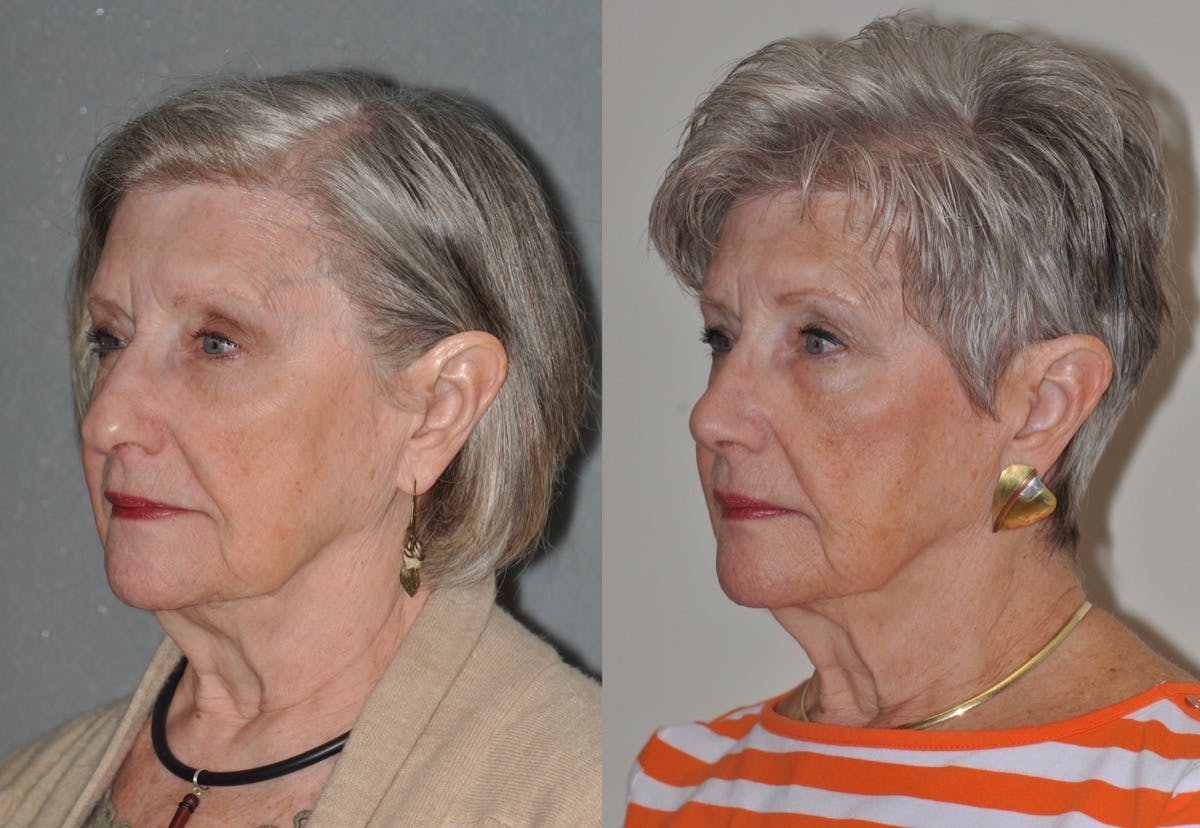 Rhinoplasty Before & After Gallery - Patient 346232 - Image 5