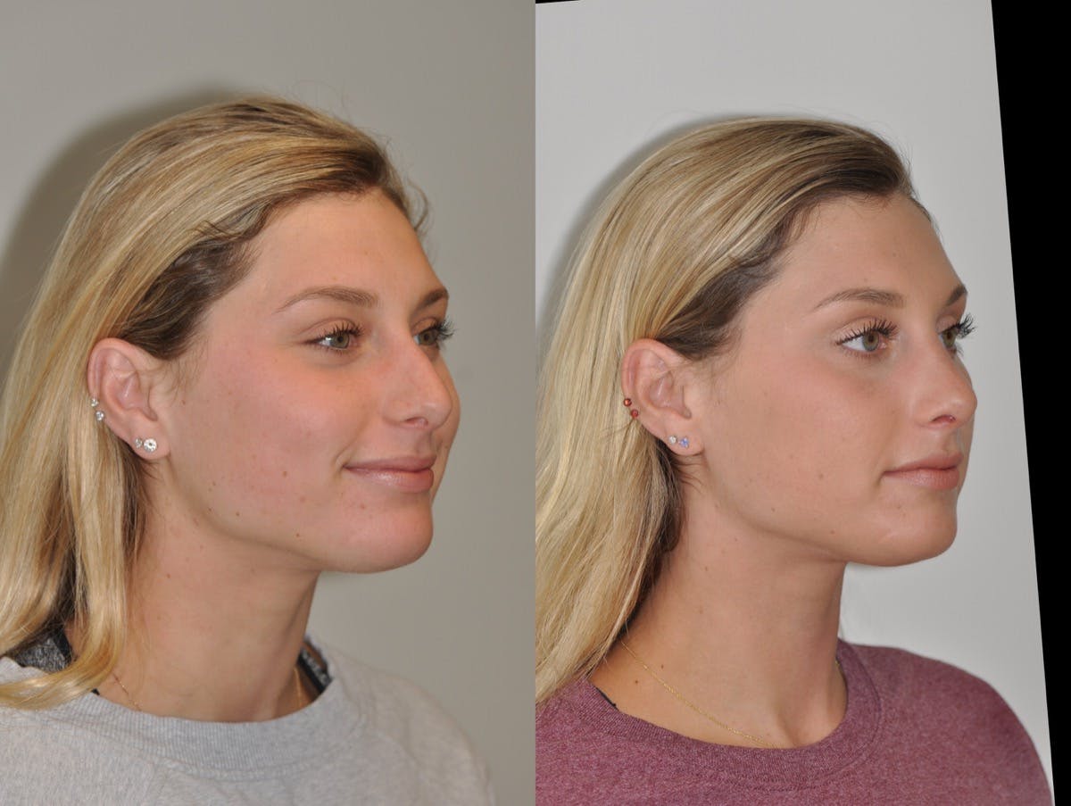 Rhinoplasty Before & After Gallery - Patient 384972 - Image 5