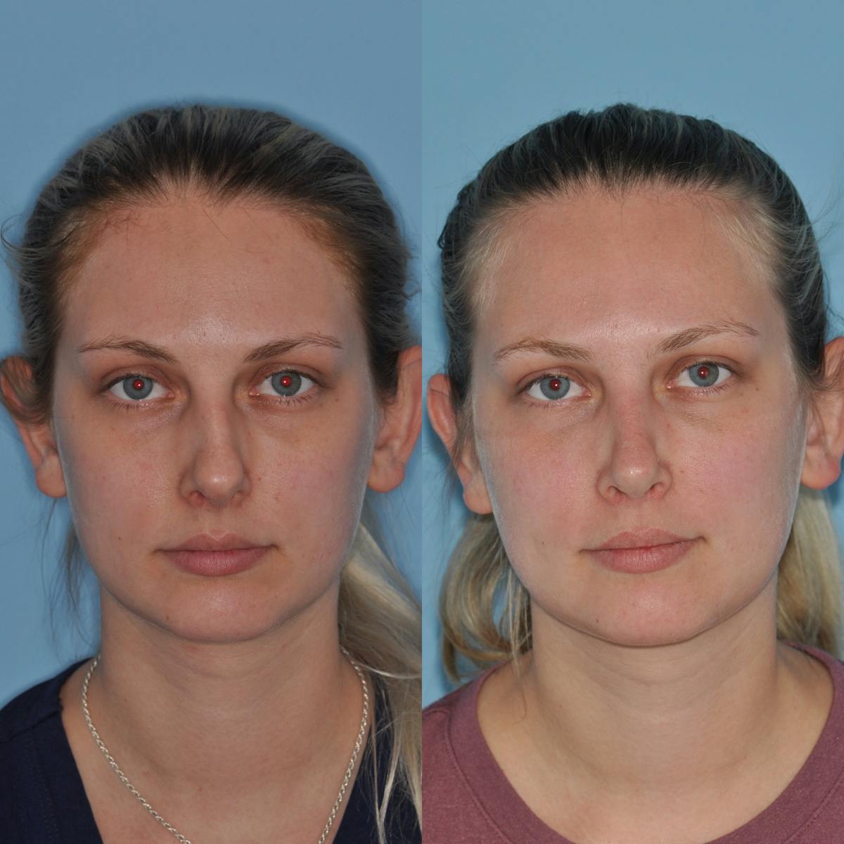 Rhinoplasty Before & After Gallery - Patient 739701 - Image 1
