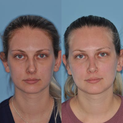 Rhinoplasty Before & After Gallery - Patient 739701 - Image 1
