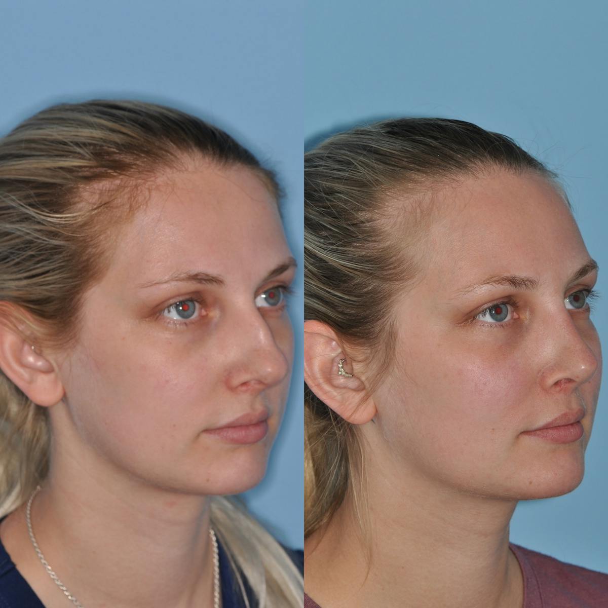 Rhinoplasty Before & After Gallery - Patient 739701 - Image 2