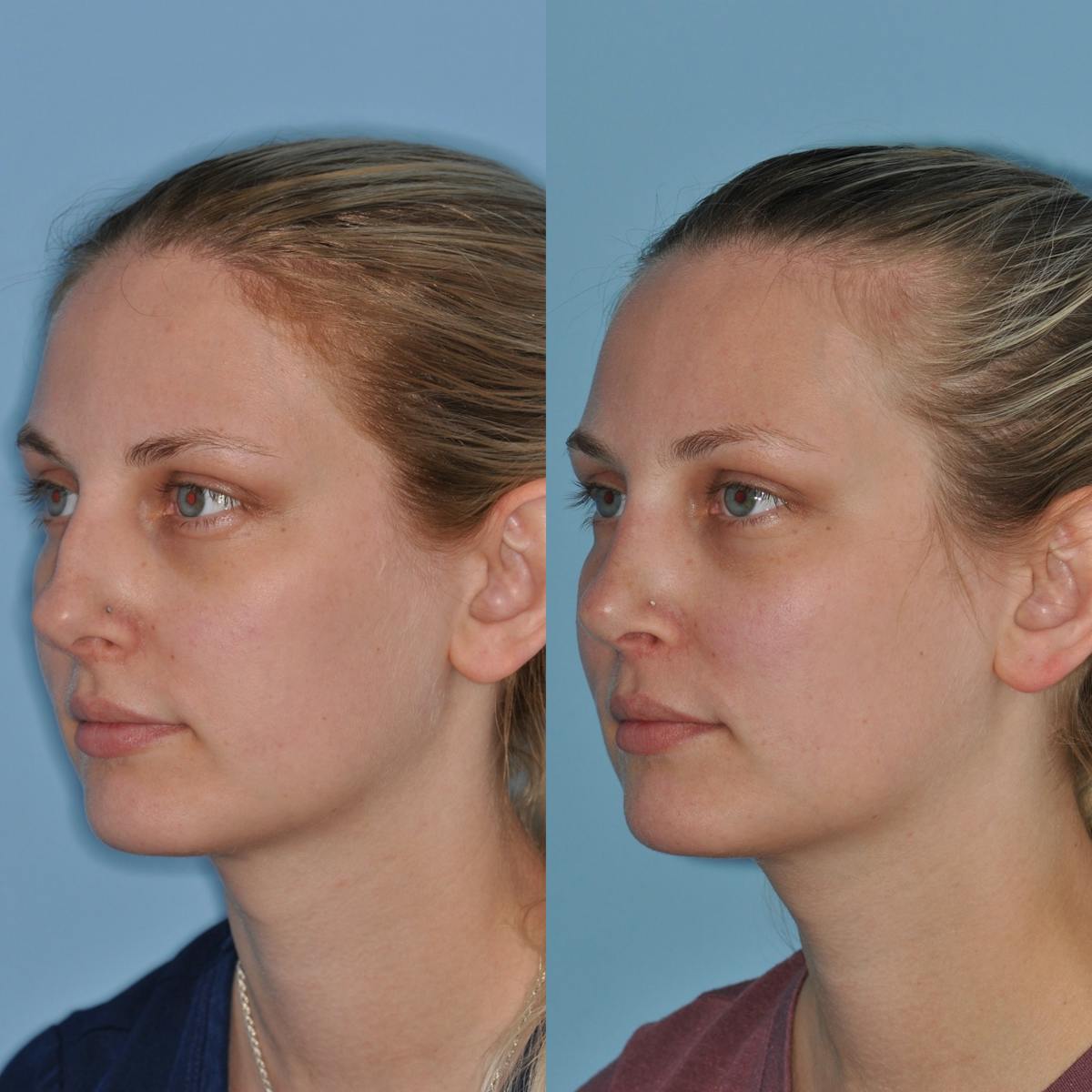 Rhinoplasty Before & After Gallery - Patient 739701 - Image 3