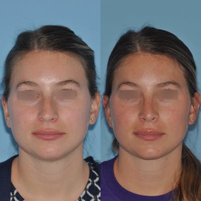 Rhinoplasty Before & After Gallery - Patient 220773 - Image 1