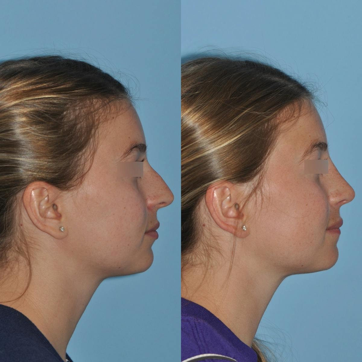 Rhinoplasty Before & After Gallery - Patient 220773 - Image 2