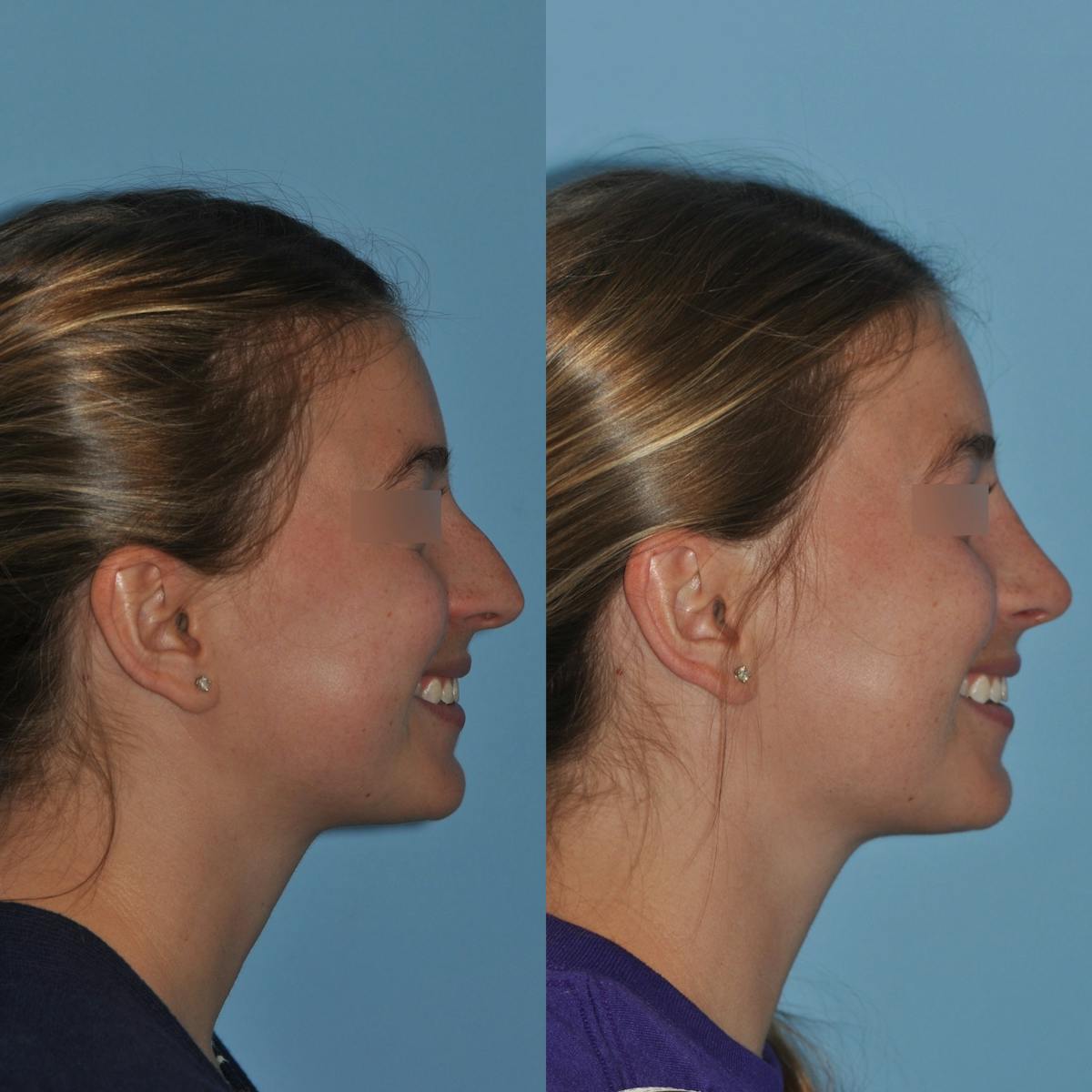 Rhinoplasty Before & After Gallery - Patient 220773 - Image 4