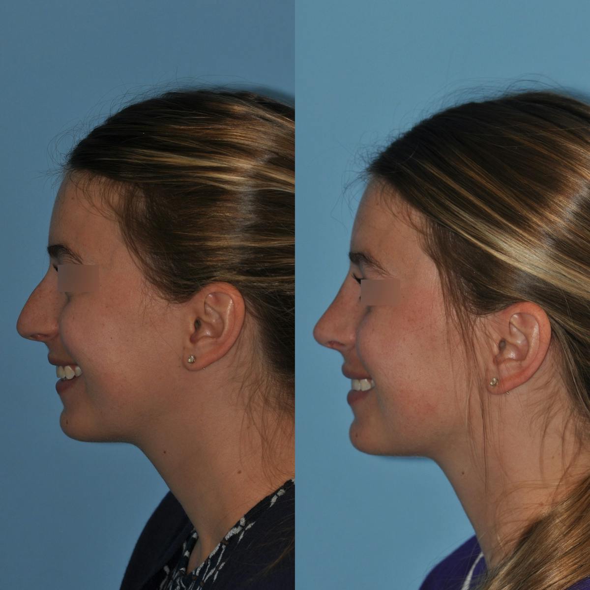 Rhinoplasty Before & After Gallery - Patient 220773 - Image 5