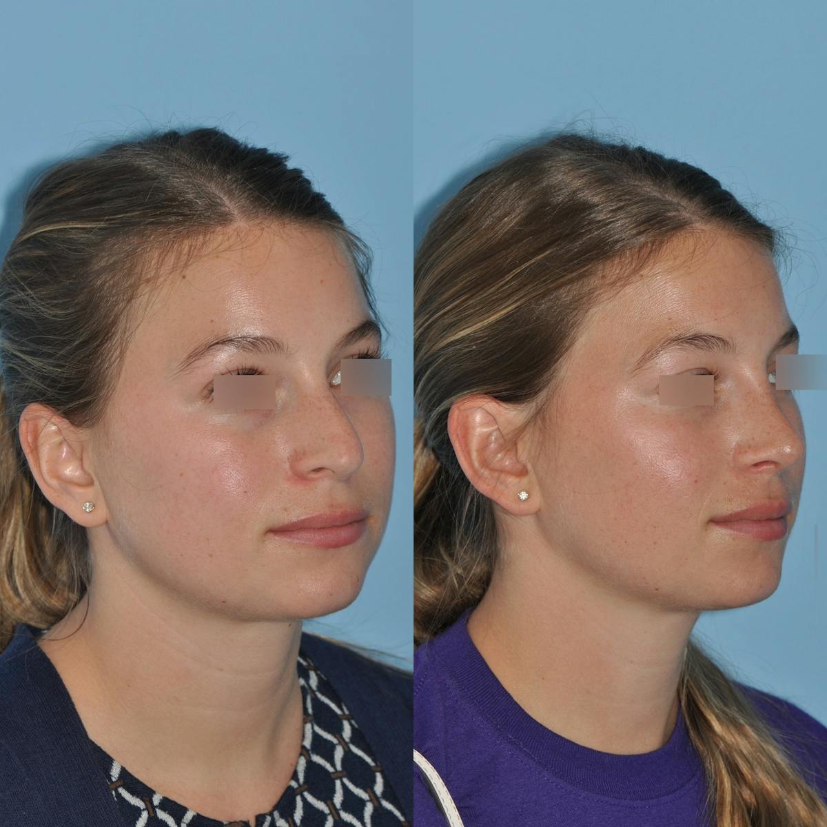 Rhinoplasty Before & After Gallery - Patient 220773 - Image 6
