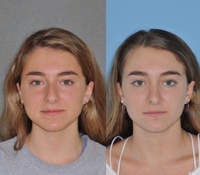 Rhinoplasty Before & After Gallery - Patient 219798 - Image 1