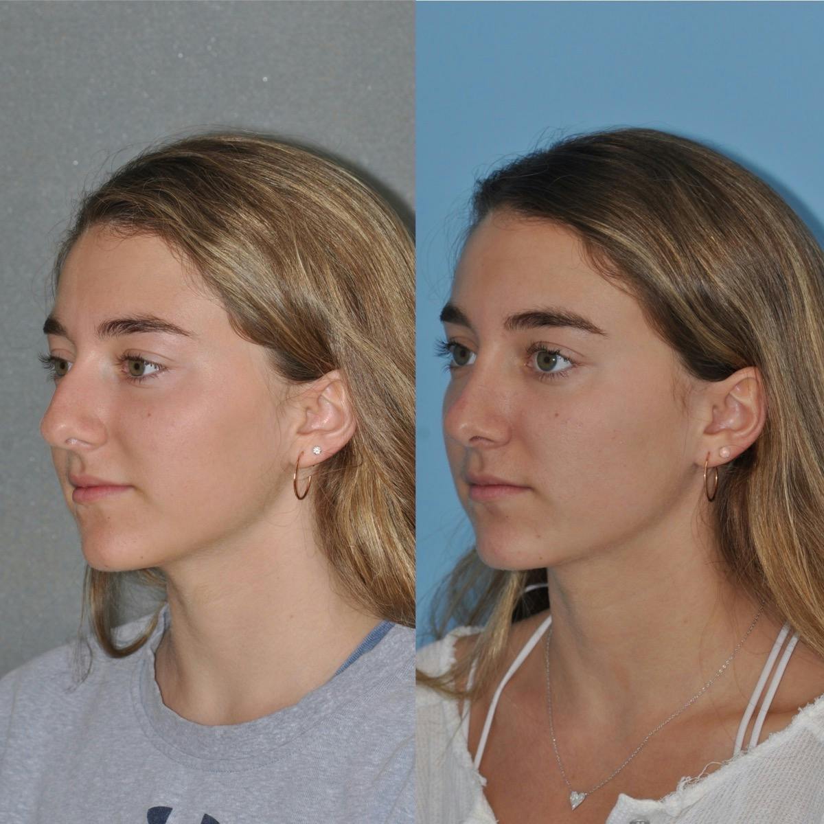Rhinoplasty Before & After Gallery - Patient 219798 - Image 2