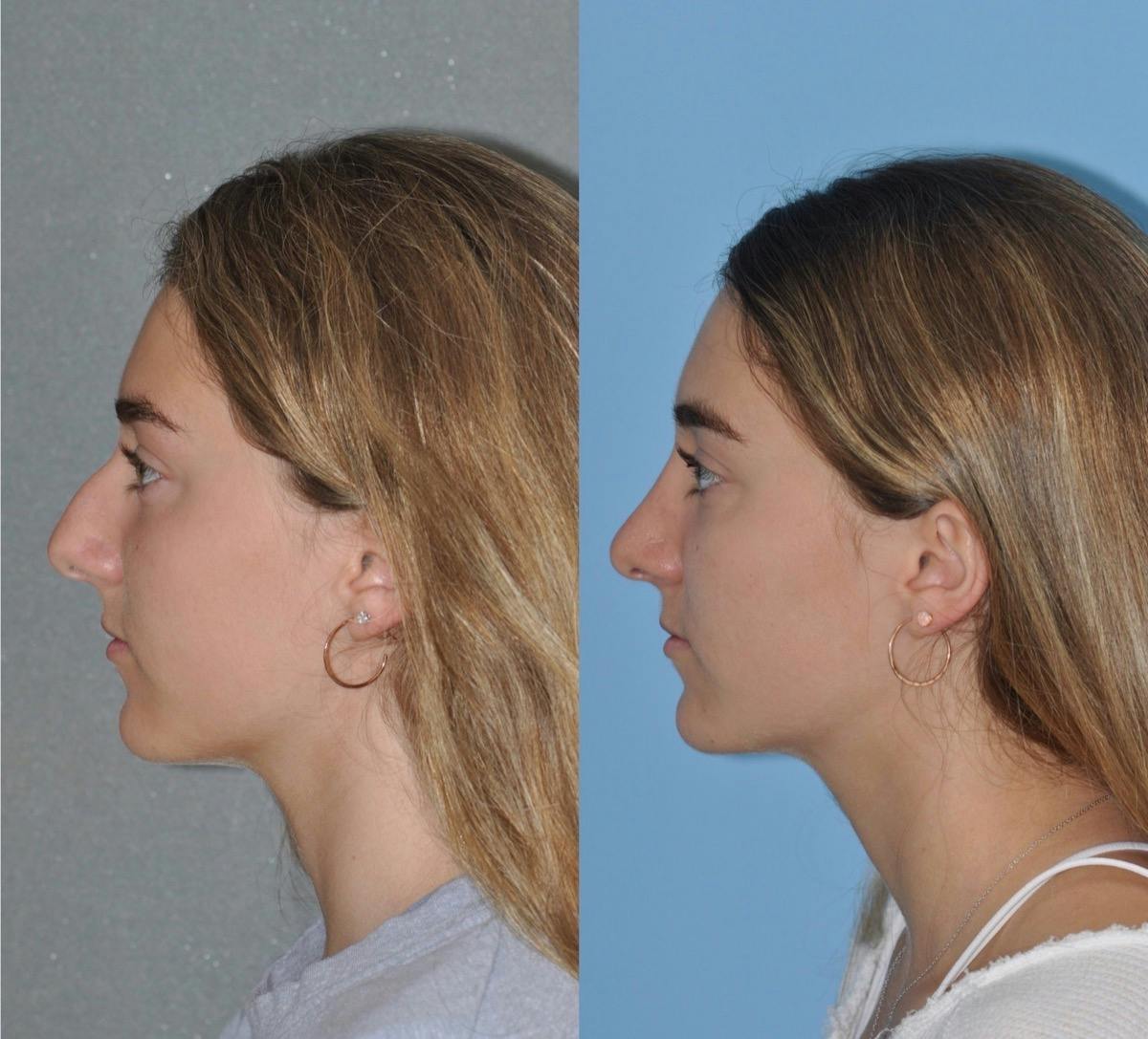 Rhinoplasty Before & After Gallery - Patient 219798 - Image 3