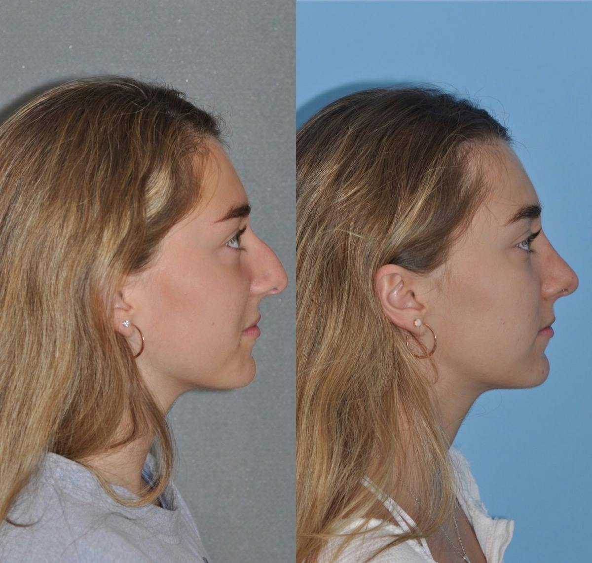Rhinoplasty Before & After Gallery - Patient 219798 - Image 4