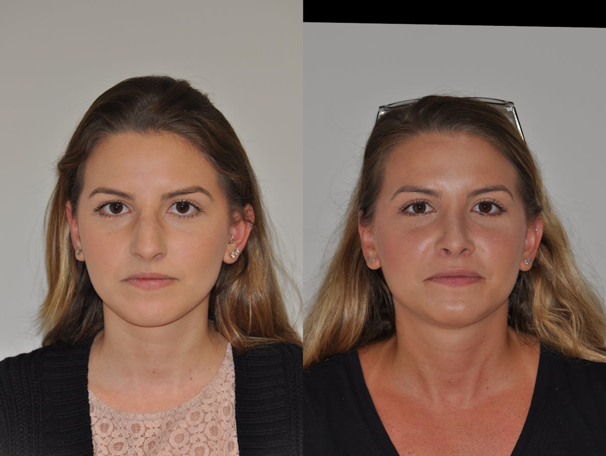 Rhinoplasty Before & After Gallery - Patient 217765 - Image 1