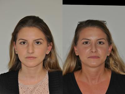 Rhinoplasty Before & After Gallery - Patient 217765 - Image 1