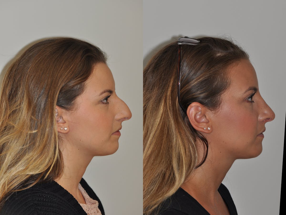 Rhinoplasty Before & After Gallery - Patient 217765 - Image 4