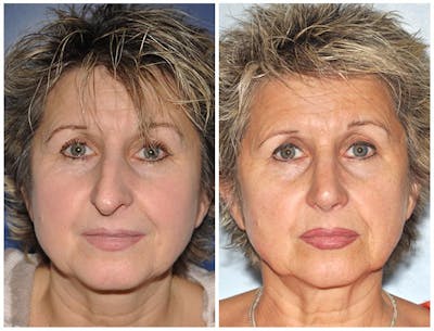 Rhinoplasty Before & After Gallery - Patient 105573 - Image 1