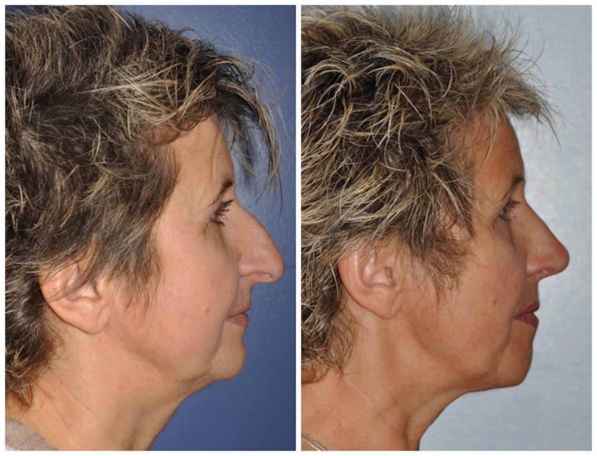 Rhinoplasty Before & After Gallery - Patient 105573 - Image 2