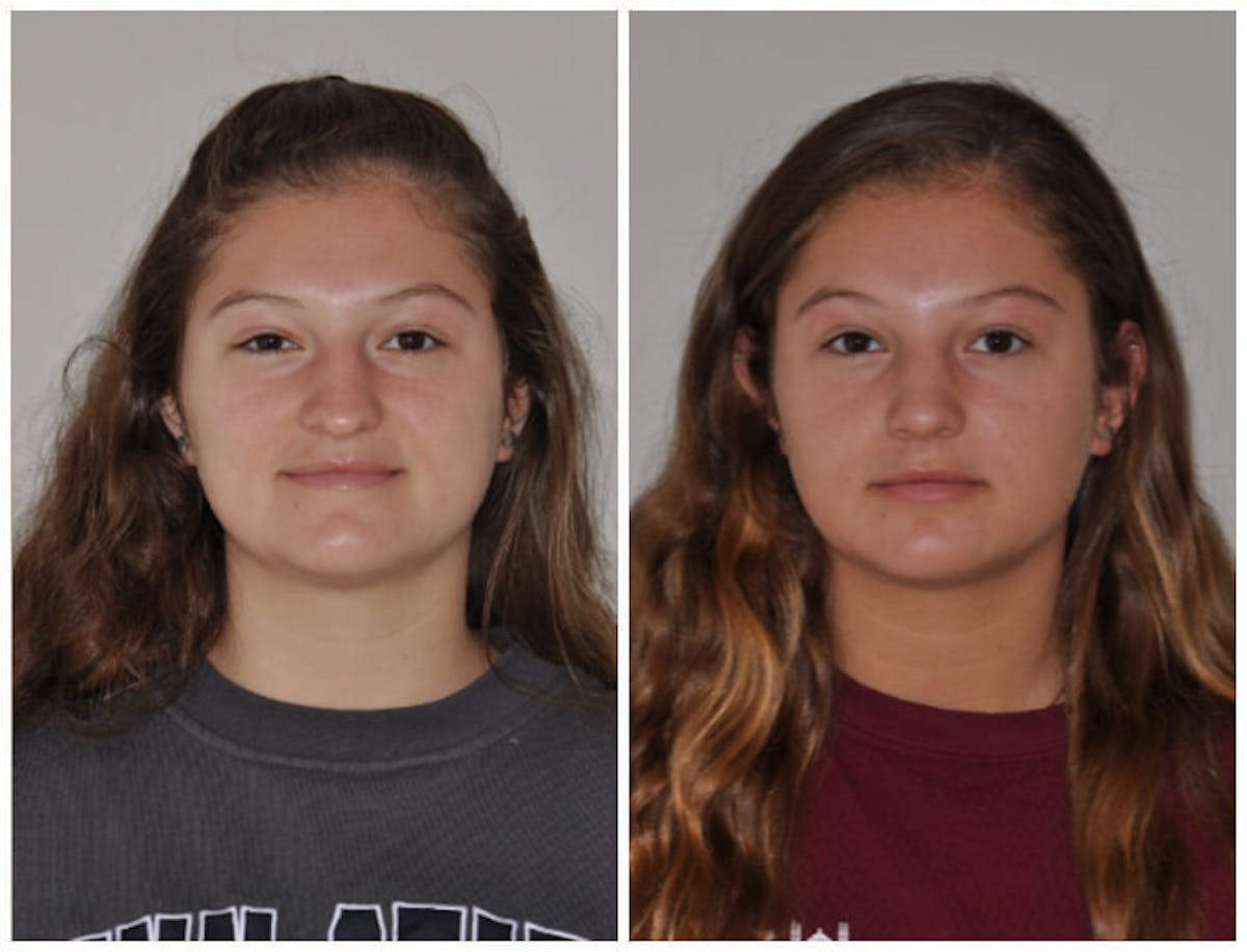 Rhinoplasty Before & After Gallery - Patient 382481 - Image 1