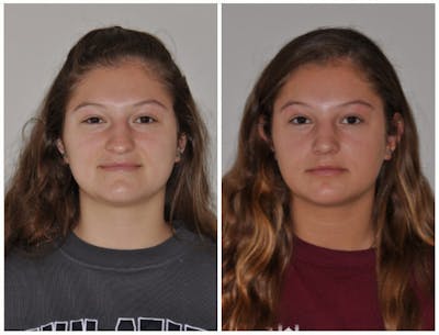 Rhinoplasty Before & After Gallery - Patient 382481 - Image 1
