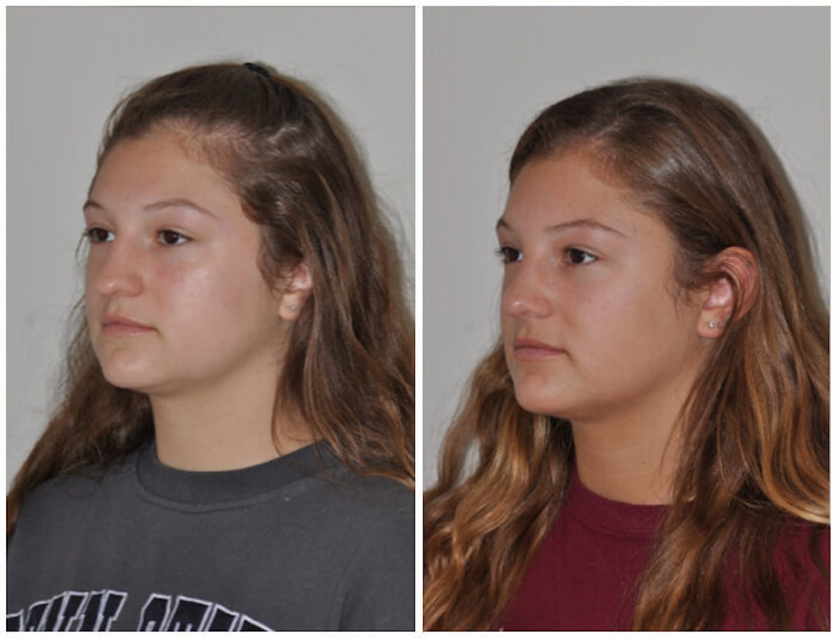 Rhinoplasty Before & After Gallery - Patient 382481 - Image 2